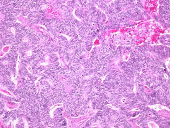 Light microscopy of a hematoxylin and eosin (H&E) stained breast tissue section demonstrates a solid architectural variant of papillary carcinoma with spindle-cell morphology. The primary subject is a malignant epithelial neoplasm of the mammary gland, imaged at microscopic level. The specimen type is a histology slide from breast tissue, and the image represents a high-power field with cellular detail. In the tumor, there are solid sheets and nests of cells with spindle to oval shapes and scant cytoplasm. Nuclei are elongated with mild to moderate nuclear atypia and relatively inconspicuous nucleoli. Mitotic figures are infrequent in this field. Focal papillary structures may be present but the dominant pattern here is solid, with delicate fibrovascular cores observed where visible. The stroma is fibrous, with limited inflammatory infiltrate and no conspicuous necrosis. Overall morphology supports a papillary carcinoma that can mimic metaplastic spindle-cell lesions, underscoring the need for thorough histologic assessment and adjunctive studies. Clinically, solid variant papillary carcinoma of the breast is typically low-to-intermediate grade with favorable prognosis, though occasional aggressive behavior has been reported. Immunohistochemical profiling and radiologic-pathologic correlation aid accurate diagnosis and guide surgical management and adjuvant therapy decisions.