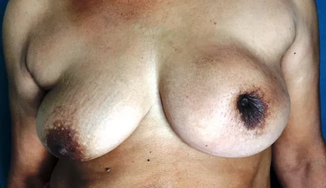 Clinical photograph of a female patient in her mid‑fifties presenting with a left breast mass. The image demonstrates an enlarged left breast with conspicuous nipple retraction and diffuse peau d’orange skin texture consistent with lymphatic obstruction and dermal edema. A firm, irregular 6 cm palpable mass is evident in the upper outer quadrant, correlating with invasive disease. The skin over the lesion shows tethering and dimpling owing to invasion of mammary ducts and stromal fibrosis. This presentation aligns with locally advanced breast cancer and is typical of invasive ductal carcinoma, which commonly presents as a hard, non-mobile lesion with skin involvement and nipple changes. In population-based screening, such cancers are often small and asymptomatic, yet clinically detected cases show palpable masses or skin changes; metastasis to axillary nodes is a consideration. Radiologic correlation (mammography/ultrasound) would typically reveal a spiculated density or irregular mass with posterior acoustic shadowing, and histopathology would confirm infiltrating ductal carcinoma. Clinically, nipple inversion and peau d’orange reflect tumor infiltration and dermal lymphatic obstruction. Early detection improves prognosis; however, skin involvement indicates higher stage. Differential considerations include inflammatory breast cancer, benign fibrocystic change, and other malignant breast neoplasms. Management requires multidisciplinary evaluation and oncologic therapy planning.