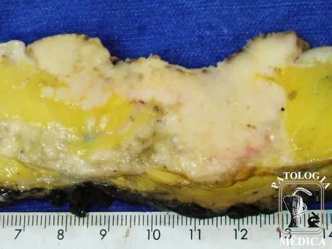 Gross pathology photograph of a human breast tissue specimen displaying a large, multifocal, high-grade invasive ductal carcinoma with extensive involvement of the overlying skin. Modality: gross pathology imaging; technique: en-face macroscopic view with scale ruler included, color in natural balance. The breast parenchyma shows multiple whitish, firm nodules interspersed within adipose tissue, with irregular, infiltrative margins. The skin over the lesion is visibly involved, exhibiting erythema and induration consistent with dermal invasion by tumor. No formal staining or contrast is applied in this gross photograph; histology would be required to confirm lymphovascular invasion. The lesion spans a substantial portion of the specimen and demonstrates heterogeneity in consistency and color, ranging from pale yellow to whitish fibrous areas. Clinically, this pattern corresponds to locally advanced breast cancer with cutaneous involvement, which has implications for staging (T4-like features), prognosis, and surgical planning (mastectomy versus breast-conserving approaches). This image serves educational purposes for trainees in pathology, oncology, breast surgery, and radiology, illustrating how invasive ductal carcinoma can present with extensive skin invasion on gross examination. Potential differential considerations include inflammatory breast carcinoma and other high-grade ductal neoplasms; correlate with imaging and biopsy for definitive diagnosis.