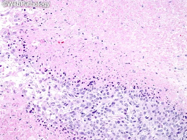 Histopathology: Hematoxylin and eosin (H&E) stained formalin-fixed paraffin-embedded breast tissue section examined by bright-field light microscopy. The specimen shows invasive carcinoma of the breast with conspicuous tumor necrosis. At the inferior/outer aspect, nests of malignant cells display high cellular density, marked atypia, pleomorphism, hyperchromatic nuclei, and conspicuous nucleoli. Mitotic activity is elevated. The tumor front invades into surrounding stromal tissue with irregular, infiltrative borders. Central regions exhibit extensive coagulative necrosis characterized by eosinophilic, acellular debris and paucity of viable tumor cells, while viable tumor nests persist at the advancing edge. A desmoplastic stromal response is variably present. The cellular architecture is consistent with high-grade ductal carcinoma; areas may display basal-like cytologic features. The Ki-67 proliferative index is typically high in such necrotic, rapidly dividing tumors. The necrosis is clinically significant as it correlates with aggressive biology, rapid growth, and potential for early recurrence or progression, particularly in tumors that are not hormone receptor–positive. This histology supports a poor prognostic profile and would prompt comprehensive systemic therapy considerations. Immunohistochemical correlation is recommended to determine ER/PR/HER2 status and to assess basal-like markers for prognostication. Correlative clinical data, including patient age, stage, and receptor profile, strengthens risk stratification and therapeutic planning for personalized management.