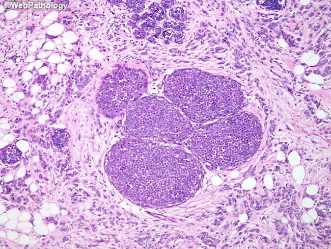 Low-power light microscopy of breast tissue stained with Hematoxylin and Eosin demonstrates invasive lobular carcinoma (ILC) with diffuse infiltration of the parenchyma and adipose fat by small uniform cells arranged in slender, linear cords and single-file patterns. The tumor cells exhibit scant cytoplasm and round to oval nuclei with mild atypia, forming non-cohesive strands that invade across the stroma, rather than forming cohesive nests typical of ductal carcinoma. In several lobules, there is accompanying lobular carcinoma in situ (LCIS) within expanded lobular units, highlighting a spectrum of lobular neoplasia. The top of the field shows a few uninvolved lobular structures, indicating focal preservation within a predominantly malignant milieu. The surrounding stroma shows mild desmoplasia in places and fat invasion by tumor cells is evident. This histology is characteristic of ILC and explains potential clinical features such as subtle breast thickening or mammographic underestimation of disease, because ILC often presents as diffuse infiltration rather than a discrete mass. Immunohistochemical confirmation (e-cadherin loss) supports diagnosis, while hormone receptor status (estrogen/progesterone receptor positive) frequently influences treatment planning. The image is valuable for educational purposes and for correlating morphology with management decisions, including surgical margins and systemic therapy considerations.