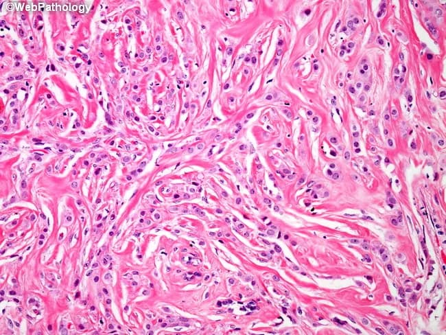 Histology-based description of invasive lobular carcinoma in breast tissue using light microscopy of Hematoxylin and Eosin stained section. The specimen demonstrates tumor cells arranged in discohesive, single‑file patterns within a dense, desmoplastic fibrous stroma. Neoplastic cells are relatively uniform with vesicular nuclei and small, conspicuous nucleoli, reflecting mild to moderate cytologic atypia typical of ILC. The stromal background is collagen-rich and extensively fibrotic, contributing to overall cellular scantiness and a characteristic sparse gland formation. Infiltration extends through the breast parenchyma with minimal formation of typical ductal structures; cells may be seen interspersed among adipocytes and along fibrous septa. The growth pattern and architectural arrangement support lobular lineage and diffuse spread, consistent with classic and mixed subtypes of ILC. Differential considerations include invasive ductal carcinoma with more cohesive nests, lobular neoplasia without invasion, and metastatic signet‑ring lesions, though mucin production is not evident here. Clinically, these histologic features inform tumor biology, suggesting potential estrogen receptor positivity and a propensity for multifocal/diffuse involvement, with implications for surgical planning and endocrine therapy. This image serves as a high‑yield educational reference for pathology trainees, researchers, and clinicians. Correlative immunohistochemistry may confirm lobular phenotype by E-cadherin loss.