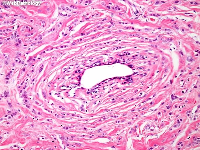 An H&E stained histology slide of breast tissue demonstrating invasive lobular carcinoma. The classic growth pattern shows small, uniform tumor cells infiltrating the fibrous stroma in single-file arrangements (Indian file) and, notably, concentric/periductal involvement around an uninvolved duct. This discohesive neoplastic population commonly lacks strong cytologic atypia, with bland round to oval nuclei and scant cytoplasm, set within a loose, fibromyxoid stroma. The architecture contrasts with the cohesive nests typical of invasive ductal carcinoma and highlights diffuse infiltration through the lobular unit rather than expansive mass formation. The infiltrative cells penetrate between native collagen bundles and adipose tissue, producing subtle architectural distortion. Although E-cadherin loss underlies lobular histogenesis, this immunophenotypic feature is not directly visible on H&E but is a well-established diagnostic correlate. Clinically, this pattern informs subtype classification, prognosis, and therapeutic planning, with implications for hormone receptor testing (ER/PR positive likelihood) and HER2 status guiding systemic therapy. Radiologic-pathologic correlation is important due to potential multifocality and satellite foci in lobular carcinoma. This image is valuable for education on lobular invasion, differential diagnosis from ductal carcinoma, and for research into targeted therapies addressing adhesion molecule pathways. Impact on surgical margin assessment and adjuvant planning should be considered clinically by teams.