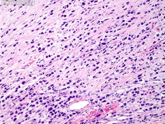 Breast histopathology image analyzed by bright-field light microscopy of formalin-fixed, paraffin-embedded tissue stained with Hematoxylin and Eosin (H&E). The lesion demonstrates invasive lobular carcinoma with a pleomorphic nuclear phenotype. Tumor cells are arranged in the classic lobular pattern with infiltrative, discohesive cells traversing a desmoplastic stroma, but display marked nuclear pleomorphism. Nuclei vary considerably in size and shape, show irregular contours, and are notably hyperchromatic. Cytoplasm is typically scant, and mitotic activity may be low to moderate depending on the field. The architectural pattern may include Indian-file strands, targetoid arrangements, and single-cell infiltration, consistent with lobular histology, but the prominent pleomorphism distinguishes it from conventional ILC. Background breast parenchyma often shows fibrous stroma and mild chronic inflammatory cells. No evident necrosis is observed in this field, though focal areas of cytoplasmic detail may be limited by processing. Clinically, pleomorphic lobular carcinoma is considered a high-grade variant with potential for more aggressive behavior than classic ILC, with implications for prognosis and treatment, including adjuvant endocrine therapy given the common hormone receptor positivity. This image is useful for pathology education, differential diagnosis training (distinguishing lobular from ductal carcinomas), and tumor grading in breast pathology.