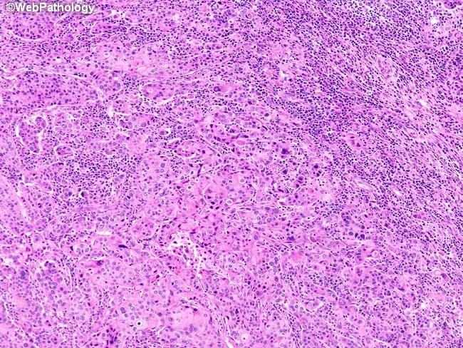 Imaging modality: Light microscopy using bright-field, Hematoxylin and Eosin (H&E) staining of a breast tissue section. Precise anatomical location: Mammary gland parenchyma, intratumoral mass within breast tissue; subtype: medullary carcinoma of the breast. Visual features: diffuse, sheet-like growth with broad cellular nests and anastomosing trabeculae; tumor cells with high-grade, pleomorphic nuclei and abundant eosinophilic cytoplasm; indistinct cytoplasmic borders producing a syncytial cytomorphology; lack of glandular differentiation and absence of an intraductal component. Microenvironment: prominent lymphoid and plasmacytic infiltrate both within and surrounding the tumor, creating a rich inflammatory milieu. Pathological interpretation: histology consistent with medullary carcinoma; margins and invasion assessed by surrounding tissue; phenotype often triple-negative with basal-like features; high cellularity contrasted by dense lymphoid infiltration. Diagnostic significance: recognition of characteristic syncytial architecture and inflammatory infiltrate supports diagnosis; prognosis is relatively favorable for medullary-type breast carcinomas compared with other triple-negative basaloid cancers; important for differential diagnosis with inflammatory/ductal carcinomas. Clinical relevance: guides treatment planning including surgery and systemic therapy; immunohistochemistry (ER/PR/HER2) and molecular profiling may clarify receptor status; imaging-pathology correlation essential for accurate classification and prognosis. In educational contexts, this image demonstrates classic medullary histology, aiding differential diagnosis awareness, grading schemes, and teaching concepts of tumor-infiltrating lymphocytes and syncytial morphology in breast pathology for students and clinicians.
