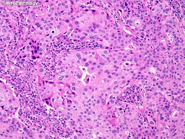 Imaging modality and technique: Light microscopy of a hematoxylin and eosin (H&E) stained thyroid tumor section, viewed at high magnification (~400x). Anatomical context: thyroid gland in the neck, parafollicular C-cell-derived medullary thyroid carcinoma. Observed architectures include diffuse growth in broad sheets, as well as solid nests and anastomosing trabeculae. Tumor cells show high-grade nuclei with conspicuous nucleoli and abundant eosinophilic cytoplasm; cytoplasmic borders are indistinct, imparting a syncytial appearance. There is little to no glandular differentiation or intraductal component. A striking, prominent lympho-plasmacytic infiltrate surrounds and permeates the tumor, a hallmark histologic feature of MTC. Background stroma may contain stromal amyloid in some cases (not always visible). Immunophenotypic expectation (not depicted): calcitonin and neuroendocrine markers positive; CEA may be expressed; TTF-1 variably positive. Diagnostic significance: the described morphology is characteristic of medullary thyroid carcinoma and helps distinguish it from papillary, follicular, anaplastic, and poorly differentiated thyroid carcinomas or metastatic neuroendocrine tumors. Clinical correlation: assess serum calcitonin and CEA; evaluate for MEN2 syndrome; RET mutation testing; imaging for primary tumor and metastasis; consider therapeutic implications and prognosis. Educational use: reference histology slide illustrating C-cell origin, syncytial tumor cells, and lymphoplasmacytic response. Correlation with amyloid deposition and calcitonin positivity may aid diagnostically.