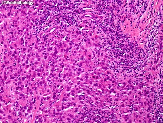 Comprehensive Description: Histopathology image of breast tissue showing medullary carcinoma. A bright-field light microscopy slide stained with hematoxylin and eosin reveals sheets of large, pleomorphic, anaplastic tumor cells arranged in solid, syncytial clusters with indistinct cell borders. The neoplastic cells often possess prominent nucleoli and abundant cytoplasm. Surrounded by a dense lymphoplasmacytic inflammatory infiltrate, the tumor demonstrates a characteristic high-grade appearance with frequent mitotic figures. Occasional tumor giant cells and focal spindle cell-like transformation may be evident. Necrosis may be present in focal areas, while calcifications are typically absent. The tumor margins may appear well circumscribed within dense fibrous stroma, with variable desmoplasia. Immunophenotype of medullary carcinoma often shows triple-negative status (ER-, PR-, HER2-) and a basal-like molecular pattern, though prognosis can be relatively favorable compared to other triple-negative breast cancers. Clinically, this histology is important to distinguish from invasive ductal carcinoma of no special type (IDC-NST) and from other medullary-like variants. The image is educational for surgical pathology, radiology-pathology correlation, and oncologic decision-making, illustrating histologic architecture (syncytial growth), lymphoid-rich stroma, necrosis, and lack of calcified deposits. This description supports differential diagnosis, prognosis estimation, and therapeutic planning in breast cancer cohorts and pathology teaching sets.