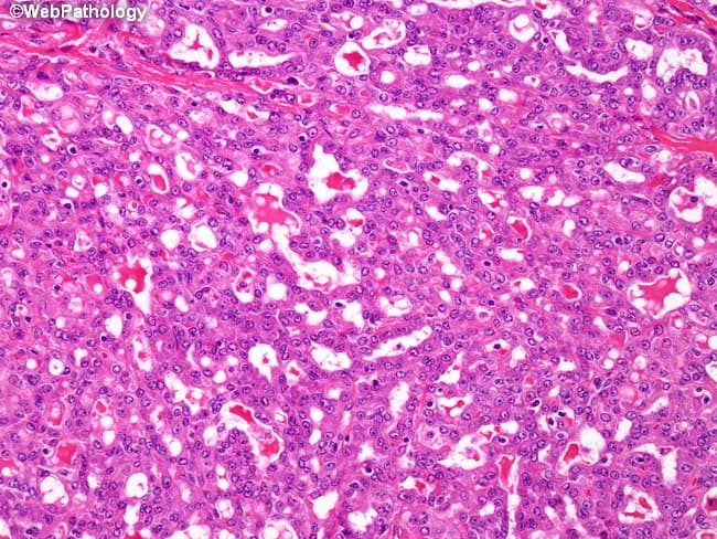 Modality: Light microscopy of hematoxylin–eosin stained salivary gland tissue, at variable magnification showing classic acinic cell carcinoma histology. The tumor arises in salivary gland parenchyma, typically in the parotid, and demonstrates serous acinar differentiation with abundant zymogen granules. The architectural pattern is dominantly ductal–tubular and microcystic, with back-to-back tubular or acinar-like structures lined by small to medium-sized cells. The cytoplasm is eosinophilic and granular due to secretory granules; numerous intracellular eosinophilic globules may be evident. A conspicuous feature is extensive acinar-type secretory material within luminal spaces and microcysts, which is PAS-positive and resistant to diastase digestion, consistent with diastase-negative mucopolysaccharide-rich secretions resembling zymogen granule content. The nuclei are generally round to oval with mild pleomorphism, and mitotic activity is typically low. The stroma may be fibrous or myxoid, and perineural invasion can be seen in some cases but is not required for diagnosis. Clinically, these lesions present as slow-growing, painless masses in the major salivary glands. The combination of tubular/solid microcystic patterns with PAS-D positive secretory material and abundant zymogen granules supports a diagnosis of acinic cell carcinoma, differentiating it from mucoepidermoid and adenoid cystic carcinomas. Immunohistochemistry often shows S-100 negative and DOG1 variable expression. Supportive for diagnosis and grading.