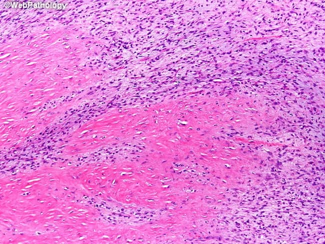 Histopathology Metaplastic spindle cell carcinoma with fibromatosis-like features of the breast. This hematoxylin and eosin (H&E) stained slide shows a combination of hypocellular and hypercellular spindle cell fascicles arranged in storiform pattern embedded within dense desmoplastic stroma containing keloid-like collagen. The spindle cells have elongated, bland to mildly pleomorphic nuclei with scant mitotic activity, low-grade cytology, and rare mitoses, consistent with a low-proliferation component. Intervening dense fibrous tissue and collagen produce a biphasic appearance, sometimes mimicking fibromatosis. In focal areas, a more cellular spindle cell proliferation is evident, but without prominent epithelial differentiation on H&E alone. Immunohistochemistry would typically demonstrate epithelial markers (cytokeratins) in spindle cells, supporting metaplastic carcinoma, and p63 or basal-type cytokeratins may be positive; vimentin is commonly positive as well. Differential diagnoses include true desmoid-type fibromatosis, spindle cell sarcomas, and other myoepithelial or myofibroblastic lesions. The diagnostic significance lies in recognizing a metaplastic process with sarcomatoid features, which informs surgical management and adjuvant therapy for breast cancer. This histology pattern should prompt correlation with clinical data, receptor status, and imaging to guide prognosis and treatment planning. Notable features include dense desmoplasia, minimal pleomorphism, and occasional inflammatory infiltrates that may complicate initial interpretation in core breast biopsies.