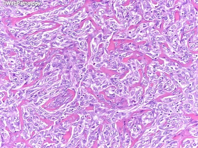 This histopathology image depicts a breast tissue specimen showing low-grade metaplastic spindle cell carcinoma, fibromatosis-like variant. Acquired via formalin fixation and paraffin embedding, the slide is stained with Hematoxylin and Eosin and examined under brightfield illumination at high magnification. The tumor target consists of plump spindle cells arranged in a storiform (cartwheel) pattern with interlacing fascicles separated by conspicuous hyalinized collagen bundles. The cells display round to oval vesicular nuclei, open chromatin, and elongated, spindle-shaped cytoplasm arranged in a slightly infiltrative, but relatively bland cytomorphology. Mitotic figures are infrequent, and nuclear atypia is mild, consistent with a low-grade appearance, yet the overall architecture indicates a malignant neoplasm with potential for local recurrence and distant metastasis. The surrounding stroma is fibrous and densely collagenous, contributing to a desmoplastic-like background. Immunophenotype may show focal cytokeratin positivity in spindle cells and p63 or high-molecular-weight cytokeratins in metaplastic carcinomas, aiding distinction from benign fibromatosis. Differential diagnoses include desmoid-type fibromatosis, myofibroblastic sarcoma, and other spindle cell neoplasms of the breast. Clinically, this lesion requires complete excision with clear margins; surveillance for recurrence and metastasis is indicated, given malignant potential despite bland histology. Correlation with imaging and clinical findings improves diagnostic accuracy and guides treatment.