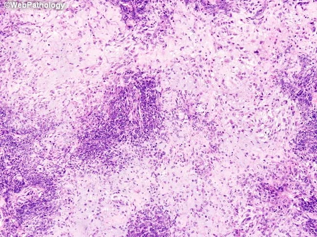Imaging modality and technique: Light microscopy of a hematoxylin-eosin stained breast tissue section. Anatomical location: breast parenchyma; histology reveals a metaplastic carcinoma dominated by undifferentiated spindle cells arranged in fascicles with marked pleomorphism, high mitotic activity, and areas of chondrosarcomatous differentiation forming dense cartilaginous matrix. Rare foci show adenosquamous differentiation with epithelial glandular elements and squamous features embedded in the spindle stroma. The lesion demonstrates biphasic morphology comprising epithelial and mesenchymal components, characteristic of metaplastic breast carcinoma. Notable features include heterogeneous cellularity, loss of cohesion in spindle cells, abundant eosinophilic cartilaginous matrix, and invasion into surrounding breast stroma. Differential diagnosis includes primary breast sarcoma and ossifying/chondroid metaplasia vs metastatic disease. When such tumors metastasize, epithelial elements may predominate or mesenchymal elements may prevail; metastases to bone can resemble primary bone tumors, complicating diagnosis. Clinically, this entity is associated with aggressive behavior, triple-negative phenotype, and poor prognosis, often requiring comprehensive immunohistochemical profiling to identify epithelial markers (cytokeratins) within the sarcomatous areas. This image is relevant for educational purposes in surgical pathology, breast oncology, and histopathology training, illustrating the spectrum of heterologous differentiation in metaplastic breast carcinoma and its diagnostic challenges in distinguishing from primary bone tumors for pathology teaching purposes.