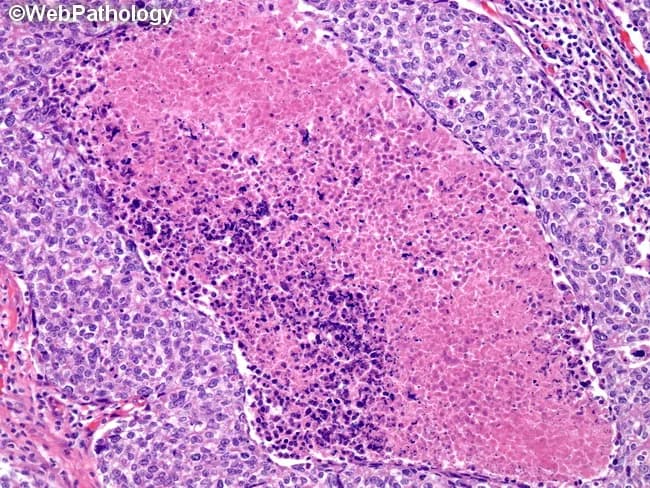 Bright-field light microscopy of an H&E-stained breast tissue section. The image captures parenchymal breast tissue with a high-grade, basal-like carcinoma component displaying geographic necrosis within tumor nests. Tumor cells are pleomorphic with hyperchromatic nuclei, conspicuous nucleoli, and scant cytoplasm arranged in solid sheets and cords; mitotic activity is brisk, contributing to the aggressive histology. The surrounding stroma shows infiltrating tumor cells at the margins, with limited luminal differentiation and a basal-type immunophenotype suggested by cytokeratin-positive basaloid cells (not shown here). This basal-like phenotype is characteristic of triple-negative breast cancers, which often lack estrogen receptor, progesterone receptor, and HER2 overexpression, and tend to behave aggressively with higher grade and poorer prognosis. The image exemplifies features used to distinguish basal-like breast carcinoma from luminal subtypes, such as geography-like necrosis and high mitotic index (>40 mitoses per 10 high-power fields) as described in published pathology resources. Knowledge of this histology supports diagnostic categorization, prognostic assessment, and therapeutic planning, including eligibility for neoadjuvant chemotherapy and enrollment in subtype-specific studies. In educational contexts, this image serves as a reference for recognizing basal-like morphology, comparing with serous ovarian tumor mutational patterns, and reinforcing the link between histology and molecular subtype stratification in breast cancer clinical practice.