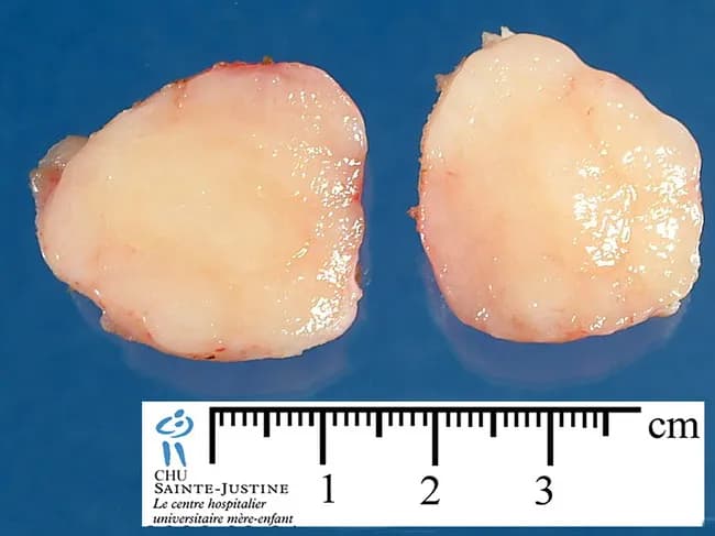 Gross pathology photograph of an excised breast lesion. Modality: gross pathology imaging; technique: external macroscopic photography with a metric ruler for size reference. The specimen is a breast hamartoma composed of mixed mature adipose tissue and fibroglandular elements. Anatomy: mammary gland tissue from the breast, with lobular-adipose admixtures; overall size approximately 2–3 cm based on the ruler. Visual features: well-circumscribed, lobulated mass with a pale pink-tan, homogeneous cut surface; smooth margins; no visible hemorrhage, necrosis, or calcification on this view. Pathology: benign hamartomatous lesion with admixture of adipose tissue and fibroglandular components; preserved architecture; no cytologic atypia is assessable on gross image. Diagnostic significance: supports benign diagnosis; radiologic-pathologic concordance important for differentiation from lipoma, fibroadenoma, or malignant breast neoplasms. Clinical relevance: low recurrence risk after complete excision; findings assist in surgical planning, patient counseling, and educational teaching; image suitable for radiology-pathology correlation, breast surgery planning, and benign breast lesion inventories. Imaging correlation: radiographs often show a well-defined mass with mixed fat and soft tissue density; histology sampling should include both fat and fibroglandular components to confirm admixture. In reports, this lesion is described as benign breast hamartoma or adenolipomatous lesion with no atypia. The image is a valuable teaching aid for radiology-pathology correlation, breast surgery planning, and benign breast lesion inventories.