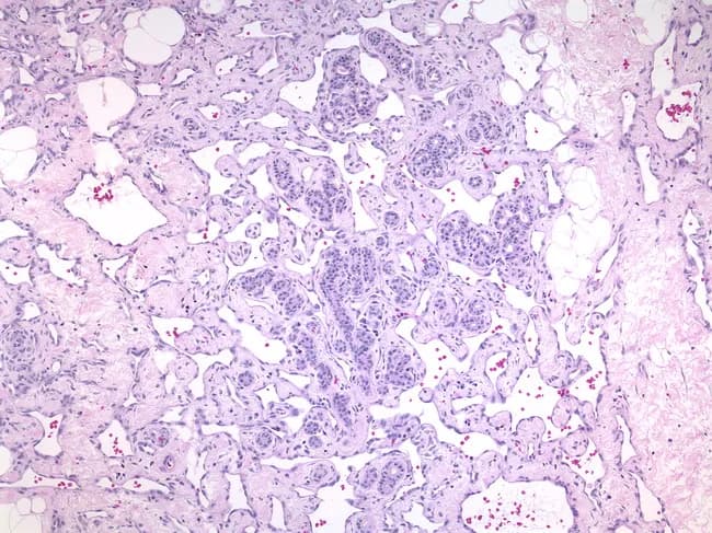Breast histopathology using light microscopy of formalin-fixed, paraffin-embedded tissue demonstrates a low-grade, well-differentiated angiosarcoma. The architecture is dominated by proliferating, open, anastomosing vascular channels that diffusely infiltrate the breast parenchyma. Lumenal spaces contain erythrocytes and show irregular calibers, contributing to a ragged vascular network. The endothelial lining displays bland cytology with minimal atypia and a low mitotic rate, distinguishing this entity from higher-grade sarcomas. Papillary formations are absent or infrequent, helping to differentiate from certain papillary endothelial proliferations. The tumor margins may blend with surrounding adipose and fibrous stroma, reflecting an infiltrative growth pattern within a limited biopsy core. Overall, the lesion’s low-grade phenotype correlates with a relatively indolent histologic appearance compared with high-grade angiosarcoma, yet clinical behavior can be unpredictable and warrants thorough evaluation. The gold-standard imaging context is histology, not radiography, with staining by Hematoxylin and Eosin providing contrast between endothelial cells and luminal spaces. Immunohistochemical confirmation (CD31, CD34, and factor VIII–related antigen) supports endothelial origin. Clinically, recognizing this pattern in breast tissue is critical for accurate diagnosis, prognosis assessment, and treatment planning, including surgical excision and consideration of adjuvant therapy, radiotherapy, or systemic therapy as indicated. This image is essential for education, pattern recognition, and research datasets globally.