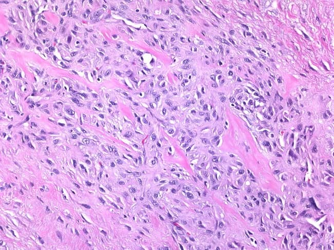 Histopathology, brightfield light microscopy, is performed on a breast tissue biopsy stained with Hematoxylin and Eosin (H&E). The image shows a classic myofibroblastoma featuring a uniform spindle cell population embedded in dense, eosinophilic collagenous stroma. Cells are fusiform with elongated, blunt-ended nuclei, scant cytoplasm, and limited mitotic activity, producing a bland cytomorphology typical of benign myofibroblastic tumors. The stromal matrix demonstrates prominent thick collagen bands arranged in interlacing fascicles, with variable cellularity. Variant patterns are recognized: collagenized forms with even denser stromal fibrosis, epithelioid variants containing polygonal to epithelioid cells that may mimic invasive carcinoma on routine sections, and myxoid variants showing a more gelatinous extracellular matrix. Immunohistochemistry (not shown) typically reveals myofibroblastic differentiation with CD34 positivity and desmin or SMA expression in a subset, while S100 is negative, aiding distinction from spindle cell sarcomas and metaplastic carcinomas. The diagnostic significance lies in distinguishing this benign stromal tumor from malignant mimics, guiding conservative surgical management and prognosis. This image demonstrates the key features of a myofibroblastoma: bland spindle cells, abundant collagen, absence of overt cytologic atypia, and low mitotic rate, consistent with benign myofibroblastic neoplasm. Recognition supports accurate diagnosis, avoids overtreatment, and informs patient prognosis and follow-up strategies in practice.