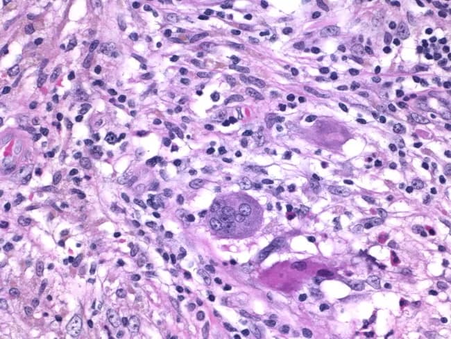 Histology of granulomatous mastitis on bright-field light microscopy. A dense inflammatory infiltrate forms granulomas centered on Langhans-type giant cells surrounded by epithelioid histiocytes, scattered lymphocytes, and occasional eosinophils. The image depicts a high-power view of the center of a granuloma within breast tissue biopsy; multinucleated giant cells with horseshoe-shaped nuclei are evident. The granulomatous architecture includes a peripheral rim of lymphocytes and histiocytes with minimal necrosis described. Staining by Hematoxylin and Eosin highlights basophilic nuclei and eosinophilic cytoplasm; pink collagenous stroma and adipose breast tissue may be visible in the background. Clinically, granulomatous mastitis can mimic infectious etiologies or neoplasia; the presence of Langhans giant cells strongly suggests a granulomatous process and warrants infectious workup for tuberculosis and fungal pathogens, as well as consideration of sarcoidosis or granulomatous reaction to foreign material. This image is diagnostic for granulomatous inflammation in breast tissue when correlated with clinical data and microbiologic studies; useful for education, differential diagnosis, and research on breast granulomatous disease. Additional educational value lies in distinguishing nonnecrotizing granulomas from caseating TB patterns, correlating histology with mammography and ultrasound, and guiding microbiologic testing and patient management in suspected granulomatous breast disease. The image supports teaching of granuloma biology and pathology.
