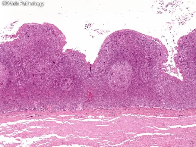 Light microscopy of a formalin-fixed neck specimen stained with Hematoxylin and Eosin reveals a cystic lesion in the lateral cervical region. The cyst is lined by squamous epithelium or ciliated columnar (respiratory-type) epithelium, reflecting branchial apparatus derivatives. Beneath the epithelial lining lies dense lymphoid tissue with prominent germinal centers, consistent with subepithelial lymphoid aggregates typical of branchial cleft remnants. The cyst cavity may contain proteinaceous material and occasionally mucin, with secondary inflammatory changes if infected. In lower neck variants, adnexal structures such as sebaceous or mucous glands can be present within the wall or adjacent tissues. A paucity of atypia supports a benign developmental lesion rather than a malignant process; rare cases show squamous cell carcinoma arising in long-standing branches, but this is uncommon. The combination of lateral neck localization, epithelial lining type, and subepithelial lymphoid tissue is characteristic and helps distinguish branchial cleft cysts from cystic metastasis, cystic hygroma, epidermoid or dermoid cysts, and thyroglossal duct cyst. Clinically relevant implications include confirming diagnosis preoperatively, guiding complete surgical excision, and counseling on infection risk and recurrence. This histology is essential for differential diagnosis, educational purposes, and research into branchial apparatus remnants and neck mass pathology.