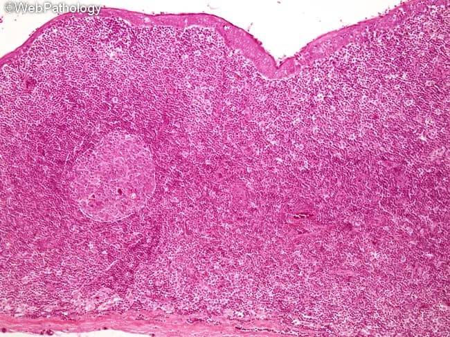 This is a histopathology micrograph (Hematoxylin and Eosin stained) illustrating a branchial cleft cyst of the lateral neck. The cyst lining consists of squamous epithelium or ciliated columnar epithelium, with a subepithelial zone of abundant lymphoid tissue containing germinal centers. The cyst wall may harbor adnexal glands, such as serous, mucinous, or sebaceous elements, particularly in lesions arising in the lower neck. The lumen often contains proteinaceous debris or keratinous material, and the surrounding stroma may show chronic inflammatory infiltrates; secondary bacterial infection is possible. Epithelium generally preserves architecture and shows no significant cytologic atypia or invasion, consistent with benign branchial apparatus remnants. Rarely, malignant transformation to squamous cell carcinoma can occur in long-standing lesions, but this is uncommon. The constellation of epithelial lining (squamous or respiratory-type), deep lymphoid tissue with germinal centers, and a cervical cystic cavity is diagnostic of branchial cleft cysts and helps distinguish them from other neck cysts such as thyroglossal duct cysts, cystic lymphangioma, epidermoid cysts, or cystic metastases. Clinically relevant correlations include lateral neck masses in children or adults, often associated with recurrent infections. Imaging and histology together guide management, surgical excision, and prognosis.