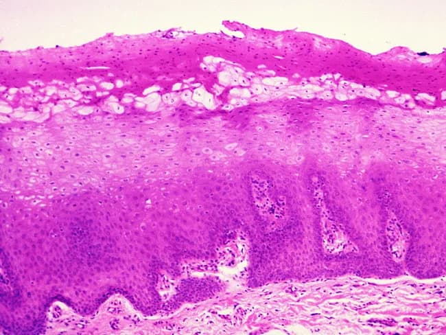 Imaging modality: Light microscopy of an oral mucosa biopsy stained with Hematoxylin and Eosin. The specimen shows classic hairy leukoplakia histology. Microscopically, there is epithelial acanthosis and parakeratotic surface with pronounced corrugation. In the upper spinous layer, a band of vacuolated, ballooned cells with abundant pale cytoplasm is evident. These dyskeratotic-appearing keratinocytes display nuclear clearing with a characteristic Cowdry type A intranuclear inclusion pattern and peripheral chromatin that appears in a beaded rim against the nuclear membrane. The basement membrane and basal cell layer remain intact, with no cytologic dysplasia. Candida hyphae infiltrate the superficial stratum corneum in roughly 80% of cases and may occur without a conspicuous inflammatory response. The lesion's erythematous-keratotic surface on mucosa may be observed macroscopically as a white-to-gray white plaque with irregular surface. Although the microscopic features are highly suggestive, confirmation can be achieved with ancillary techniques, including EBV-encoded RNA in-situ hybridization, immunohistochemistry for EBV latent membrane protein, or PCR, to demonstrate EBV within keratinocyte nuclei. Clinically, hairy leukoplakia occurs in the setting of immunosuppression (notably HIV infection) and recognition is important to guide management. No dysplasia indicates benign-viral keratinocytic change rather than malignant transformation. This image underscores the classic viral cytopathic pattern for education.
