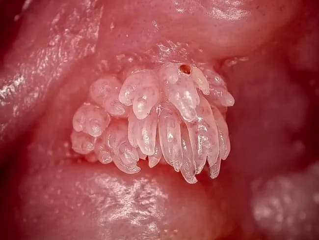 Imaging modality: Clinical photography of an intraoral exophytic lesion. Location: oral mucosa, most commonly tongue, soft palate, lips; this image shows a clustered, pedunculated, cauliflower-like eruption with finger-like projections. Size small, up to 0.5 cm; color white-pink depending on keratinization. The lesion is soft and non-tender. The appearance is characteristic of oral squamous papilloma, HPV-induced, most often HPV types 6 and 11. Pathology: benign proliferative lesion with papillary fronds lined by stratified squamous epithelium; hyperkeratosis; koilocytes may be present; fibrovascular cores. Etiology: human papillomavirus infection; transmitted via direct contact; common in pediatric and adult populations; slight male predominance. Imaging features: not radiographic; no imaging modality beyond clinical photography. Differential: verruca vulgaris, condyloma acuminatum, focal epithelial hyperplasia (heck disease), other exophytic mucosal lesions including papilloma; need histopathology to differentiate. Clinical significance: benign, low risk of malignant transformation; complete excision recommended to prevent recurrence; recurrences possible if HPV persists; counsel on HPV transmission. Utility: this image is useful for education, differential diagnosis of oral exophytic lesions, and correlating clinical appearance with HPV-related papillomas; could support cases in dental clinics, oral surgery, pathology teaching, and dermatology resources. Note: clinical correlation with examination and biopsy is advised for definitive diagnosis. HPV typing may guide management and counseling.