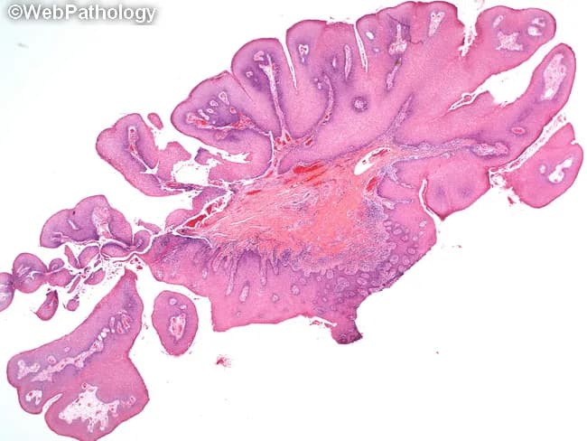 Low-magnification light microscopic image of an oral mucosal lesion with a pedunculated, papillomatous architecture. Finger‑like papillary fronds project from a surface epithelium, each projection containing a fibrovascular core. The lining is keratinized stratified squamous epithelium with a preserved maturation pattern to the surface. Hyperkeratosis may give the lesion a white clinical appearance. Koilocytes can be present in superficial layers, indicating human papillomavirus–associated change, while basilar hyperplasia and mild basilar mitotic activity may occur without true dysplasia. There is no invasion or marked architectural disarray. The subepithelial stroma is minimally inflamed, and the connective tissue darkly stained at higher power due to its fibrovascular composition. Overall, features are compatible with an oral squamous papilloma, a benign exophytic lesion. Differential considerations include verruca vulgaris and condyloma acuminatum, but the absence of significant koilocytic atypia or epithelial dysplasia supports a benign diagnosis. Clinically, such lesions are usually pedunculated, exophytic, and white when keratinized, often occurring in the oral cavity of children or young adults. Surgical excision is typically curative with low recurrence risk. This image emphasizes classic papillomatous growth, keratinized surface, and benign histology, useful for teaching oral pathology, differential diagnosis, and HPV-related mucosal lesions, including diagnostic pitfalls in distinguishing from papillary carcinomas.