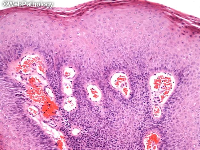 Histology, light microscopy of an oral mucosa biopsy stained with Hematoxylin and Eosin (H&E). The specimen shows a benign squamous papilloma with exophytic papillary projections arising from the surface epithelium. Each papillary frond contains a central fibrovascular core surrounded by keratinizing stratified squamous epithelium, exhibiting mild acanthosis and preserved maturation without dysplasia. The surface is often hyperkeratotic, producing a slightly corrugated or finger-like contour. The underlying lamina propria is fibrous and vascular, with chronic inflammatory infiltrate in keeping with a reactive mucosal lesion. No invasion of the basement membrane is observed, and margins (if excised) are free of tumor. Clinically, this lesion presents as a small, pedunculated or sessile oral growth that is typically benign and curable by simple excision, with rare recurrence. Differential considerations include verruca vulgaris and condyloma acuminatum, which can share papillary architecture but differ in HPV association and distribution. The lesion's benign behavior and lack of malignant transformation make it important to distinguish from squamous cell carcinoma in educational and diagnostic contexts. This image is valuable for education in oral pathology, histopathology teaching, and correlation with clinical oral lesions. This image thus supports educational objectives in surgical pathology, oral medicine, and histology curricula, reinforcing recognition of benign papillomatous lesions.