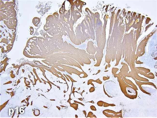 Imaging modality: Histopathology with immunohistochemistry for p16INK4a. The specimen is a pharyngectomy from an oropharyngeal tumor. The image shows invasive squamous cell carcinoma arising in oropharyngeal mucosa, with nests and cords of malignant squamous cells permeating fibrous stroma. Tumor architecture includes areas of keratinization and intercellular bridges, sometimes observed as keratin pearls, set against a desmoplastic background. Cellular morphology features enlarged, pleomorphic, hyperchromatic nuclei, conspicuous nucleoli, and brisk mitotic activity. The p16 immunostain yields diffuse, strong brown cytoplasmic and nuclear labeling in neoplastic cells, consistent with HPV-associated carcinoma; non-neoplastic squamous mucosa and inflammatory elements show little to no staining. The specimen demonstrates invasion beyond the epithelial layer into submucosa and adjacent tissue planes, enabling margin assessment. Clinically, p16 positivity serves as a surrogate marker for high-risk HPV infection and has prognostic and therapeutic implications in oropharyngeal squamous cell carcinoma (OP-SCC). Differential considerations include HPV-related versus HPV-unrelated OPSCC; HPV-driven tumors tend to have better prognosis and may respond differently to therapy. This image is relevant for educational purposes, HPV-based etiologic distinction, and research on oropharyngeal tumor biology, diagnosis, and pathology workflow, including IHC interpretation and pathology reporting. This combination supports accurate HPV typing, aids therapeutic stratification, and guides margin status assessment.