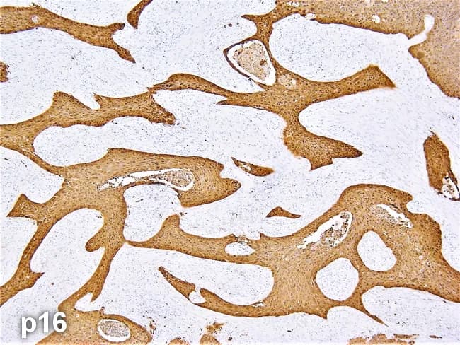 This histology image is a paraffin-embedded pharyngeal tissue section subjected to p16 immunohistochemistry, illustrating HPV-associated oropharyngeal squamous cell carcinoma. Brightfield light microscopy reveals invasive squamous carcinoma characterized by irregular nests and cords of malignant epithelial cells infiltrating a fibrous stromal backdrop. The tumor cells display pleomorphism with hyperchromatic nuclei, conspicuous nucleoli, mitotic figures, and scant keratinization in places, a non-keratinizing or basaloid morphology typical of HPV-driven cancers. The p16 immunostain produces diffuse strong cytoplasmic and nuclear positivity concentrated within the malignant cell populations, with little staining in adjacent non-neoplastic mucosa. The staining pattern supports an HPV-mediated oncogenic pathway and correlates with improved clinical prognosis compared to HPV-unrelated head and neck cancers. The pharyngeal origin is suggested by anatomical context and tissue architecture of the epithelium, with invasion into the surrounding stroma indicating a malignant process rather than a reactive lesion. Clinically, this finding informs staging and therapeutic planning, as HPV-positive oropharyngeal cancers often respond well to radiation-based regimens. Additional differential considerations include other HPV-associated lesions or salivary gland-type neoplasms, though the diffuse p16 positivity and histology here strongly favor HPV-driven squamous cell carcinoma in the oropharynx. This image exemplifies diagnostic workflow of HPV status integration into head and neck cancer management.