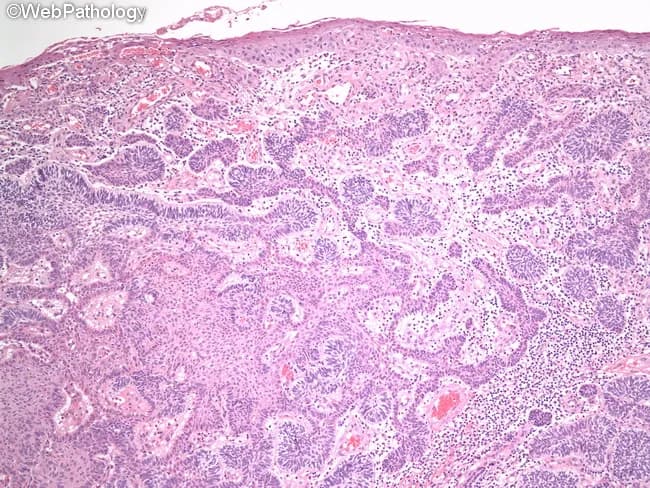 Comprehensive Description: Histology image of a peripheral (extraosseous) ameloblastoma involving oral mucosa of the mandible. Modality: Light microscopy of formalin-fixed, paraffin-embedded tissue; staining: Hematoxylin and Eosin (H&E). The surface mucosa appears intact with underlying lamina propria populated by odontogenic epithelium forming islands and cords. In the follicular pattern, nests of ameloblastic epithelium display peripheral palisading of columnar cells with reverse polarity against a basement membrane, and a central stellate reticulum–like zone resembling developing enamel organ. The nests are embedded in a mature, densely fibrous to loosely arranged connective tissue stroma. In the plexiform pattern, interconnecting thin cords or sheets of basaloid cells traverse the stroma, frequently lacking classic peripheral palisading and reverse nuclear polarity, with more loosely arranged cells within the cords. The surrounding stroma is vascularized loose connective tissue. Features mimic the intraosseous counterpart seen in jaw lesions but arise in soft tissue. Clinically, peripheral ameloblastoma is benign but locally aggressive with potential for recurrence after incomplete excision. This image supports recognition of characteristic histologic hallmarks, aids differential diagnosis from basal cell lesions and other odontogenic tumors, and informs surgical planning and prognostic assessment. Educational relevance includes teaching follicular vs plexiform morphologies and enamel organ–like architecture in peripheral contexts.