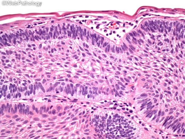 Imaging modality: light microscopy of Hematoxylin and Eosin stained paraffin section of gingival mucosa. Primary subject: peripheral ameloblastoma. Specimen: soft-tissue gingival/alveolar mucosa lesion. Perspective: transverse histologic section of mucosa. The image shows multiple islands and cords of odontogenic epithelium embedded in a dense fibrous stroma beneath the surface stratified squamous epithelium. At the periphery, tall columnar ameloblast-like cells display polarized, basophilic nuclei with reverse polarity; this peripheral palisading is juxtaposed to a central stellate reticulum-like zone. The islands are occasionally elongated and interconnected, with clear demarcation from the surrounding connective tissue. The overlying epithelium may be hyperplastic but lacks invasion into underlying bone. The stromal tissue is fibrous, moderately cellular, with delicate inflammatory cells. These histologic features are characteristic of benign odontogenic tumors confined to the soft tissue, with minimal atypia and low mitotic activity. Clinically, peripheral ameloblastoma presents as a slow-growing gingival mass that mimics reactive lesions; definitive therapy is conservative excision with clear margins. Prognosis is favorable, but local recurrences occur in 15-20% of cases, necessitating re-resection if recurrence is detected. Rare malignant transformation is described in literature. This image demonstrates classic peripheral ameloblastoma histology and serves educational purposes for pathology, oral surgery, and dental education. Educational use.
