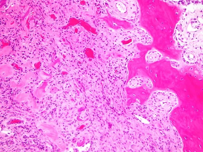 Histopathology of a gingival peripheral ossifying fibroma. Light microscopy using Hematoxylin and Eosin staining shows a dense fibrous stroma with proliferating spindle-shaped fibroblasts arranged in fascicles and whorls, with relatively low mitotic activity and mild chronic inflammatory infiltrate at the periphery. The stroma is intimately associated with scattered mineralized deposits representing a mineralized matrix. Notable mineralization includes dystrophic calcifications, cementum-like material, and small bony trabeculae or lamellar bone, consistent with ossifying changes. In older or healed areas, well-formed lamellar bone or cementum-like tissue is seen within the fibrous matrix. The lesion is typically confined to gingival tissue and may cause surface erosion or ulceration; histology demonstrates a reactive, non-neoplastic process with a fibrous proliferative component and focal calcified masses. The diagnostic significance is that presence of calcified material within a fibrous gingival lesion supports POF diagnosis, distinguishing it from fibroma or pyogenic granuloma. Differential considerations include irritational fibroma, cemento-ossifying fibroma, peripheral odontogenic fibroma, and pyogenic granuloma with calcifications. Clinically, this histology aligns with a gingival mass in the anterior maxilla or mandible, excised as part of periodontal therapy. Therapeutic implications include conservative excision with close follow-up due to potential recurrence. The specimen's micrograph underscores the biphasic pattern: fibrous stroma and mineralized nodules.