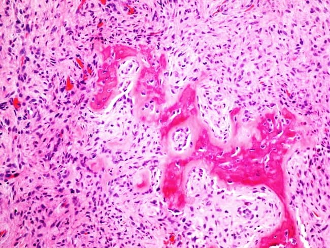High-power light microscopy of an oral soft tissue biopsy stained with Hematoxylin and Eosin reveals a lesion consistent with peripheral ossifying fibroma. The overall architecture shows a relatively well-circumscribed, hypocellular to mildly cellular fibrous stroma populated by bland spindle-shaped and ovoid fibroblasts, with sparse mitotic activity and minimal atypia. Intermixed within the fibrous matrix are mineralized bony trabeculae, some of which are woven bone, indicating osteogenic differentiation within the lesion. The lamellar mineralization forms irregular islands that disrupt the uniform fibrous background, aligning with characteristic ossification seen in this entity. Inflammatory cells are limited, and the lesion lacks marked necrosis or malignant features. Vascular channels are present but not prominent, contributing to a vascular but non-aggressive appearance. The combination of a fibrous proliferative process with discrete osseous formation in the gingival/periodontal region is classic for a peripheral ossifying fibroma, a reactive, gingival overgrowth linked to irritation or trauma. Clinically, this histology supports conservative surgical excision with careful curettage to minimize recurrence. Differential considerations include fibroma, pyogenic granuloma, and other ossifying/subosseous lesions, but the presence of bone trabeculae within a fibrous lesion strongly favors peripheral ossifying fibroma. Correlation with clinical findings and radiographic imaging aids definitive diagnosis. Clinical correlation advised.