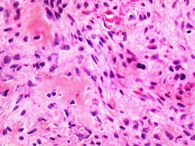 Imaging modality: Light microscopy of a hematoxylin and eosin (H&E) stained histology section. An oral gingival lesion, consistent with peripheral ossifying fibroma, shows a fibrous connective tissue stroma with osteoid matrix formation. The primary tissue features include bland, spindle-shaped fibroblasts arranged in sweeping fascicles and septa, with minimal atypia and low mitotic activity. Lakes of eosinophilic osteoid or bone-like material are identifiable within the fibrous matrix, sometimes accompanied by calcifications. The lesion exhibits mild chronic inflammatory infiltrate and increased vascularity perithreshold to the stroma. The osteoid matrix indicates osteogenic differentiation and is the key diagnostic feature distinguishing this entity from a simple fibroma. The overall architecture blends reactive fibrous tissue with calcified deposits, supporting a diagnosis of peripheral ossifying fibroma rather than other gingival lesions. Differential considerations include fibroma with calcifications, cemento-ossifying fibroma, pyogenic granuloma, and ossifying fibroma; clinical correlation and radiographic context help refine the impression. Clinically, these lesions arise from the interdental gingiva, predominantly in younger individuals, and are treated by complete surgical excision with removal of the lesion base; recurrence is possible. This image is valuable for dental pathology education and differential diagnostic training, illustrating characteristic fibroblastic proliferation coupled with osteoid formation. For clinical teaching and research.