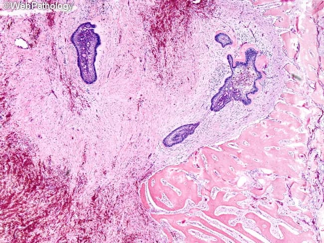Light microscopic histopathology of a desmoplastic ameloblastoma. Imaging modality: Brightfield hematoxylin-eosin stained tissue section, scanned at low-to-intermediate magnification to reveal structural context within the jaw bone. The tumor shows islands, cords, and narrow strands of odontogenic epithelium embedded in a densely collagenized, fibrous stroma (desmoplasia). Epithelial nests consist of cuboidal to columnar cells with scant cytoplasm and hyperchromatic nuclei; peripheral basaloid cells may exhibit loose alignment rather than classic palisading. Central regions lack a prominent stellate reticulum, consistent with desmoplastic morphology. Surrounding stroma is markedly hyalinized and densely fibrous, often with wedge-shaped or kite-like stromal condensations that compress adjacent osseous trabeculae. Occasional chondro-osseous metaplasia or calcifications can be seen, though not obligatory. The lesion is typically benign, slow growing, and locally invasive, with no malignant cytology evident in this field. Immunoprofile is supportive but not decisive; transforming growth factor beta driven desmoplasia contributes to the sclerotic background. Clinically, desmoplastic ameloblastoma may present as a mixed radiolucent-radiopaque jaw lesion, frequently in anterior mandible. Recurrent behavior is possible without wide local excision. This histology helps distinguish the desmoplastic variant from follicular or plexiform patterns and guides surgical planning and prognosis. Correlative radiology and clinicopathologic data enhance diagnostic confidence and treatment planning for jaw lesions.