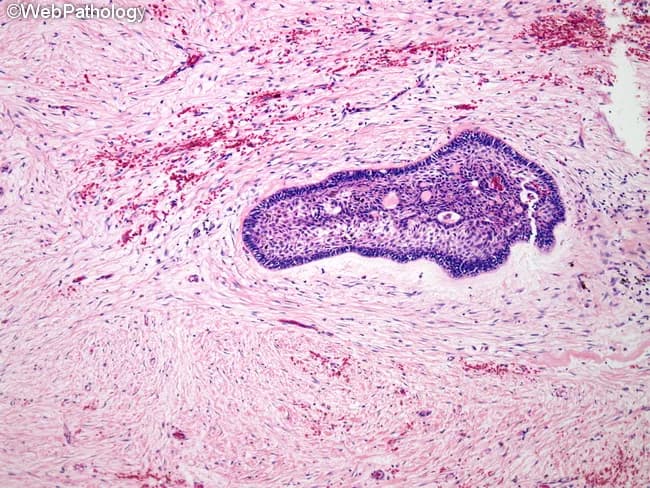 Histopathology of ameloblastoma, desmoplastic variant, on a Hematoxylin and Eosin stained slide from jaw bone tissue. The lesion shows dense, sclerotic stroma with compressed bone trabeculae and scattered islands and thin cords of odontogenic epithelium embedded in the fibrous matrix. Epithelial components consist of cuboidal to columnar cells, with partial reverse polarity, and areas reminiscent of stellate reticulum are minimal or absent. Peripheral palisading is often not evident in this variant. The stroma demonstrates marked desmoplasia with abundant type I collagen and sparse inflammatory infiltrate. Keratinization is uncommon, and mitotic activity is typically low. The tumor is locally infiltrative despite its benign designation, and the desmoplastic pattern can mimic fibrous or desmoplastic fibromatous lesions radiographically. Diagnostic significance rests on identifying odontogenic epithelium within a densely fibrous milieu, consistent with desmoplastic ameloblastoma, a distinct histologic subtype of ameloblastoma. Differential considerations include conventional ameloblastoma subtypes (follicular, plexiform), fibrous dysplasia, odontogenic fibroma, and fibromatosis. Clinically, lesions tend to occur in the anterior jaws and may present as swelling. Surgical management requires complete excision due to recurrence risk. This image is educational for pathology training, histology atlases, and radiology–histology correlation studies. Interpretation should integrate clinical context, radiographs, and immunohistochemical confirmation when available, guiding management.