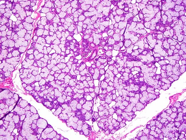 This histology image depicts sublingual salivary gland tissue examined by light microscopy after routine hematoxylin and eosin staining. The mucous acini predominate, appearing as large, pale-staining units with mucus-filled cytoplasm and relatively flattened basal nuclei; serous demilunes are minimal or absent in this field. Acini are arranged in a lobular architecture embedded in a connective tissue stroma that contains scattered capillaries and occasional adipose elements at the periphery. The excretory duct system is relatively inconspicuous compared with serous-rich glands such as the parotid or mixed glands like the submandibular; ducts are small, inconspicuous channels coursing between acini and encased in slender septa. The overall pattern reflects the mucous-dominant phenotype characteristic of the sublingual gland, with larger mucous acini than those observed in the submandibular counterpart. The image emphasizes glandular polarity with secretory cells facing a lumen and myoepithelial cells surrounding acini and ducts. Clinically, this histology supports identification of sublingual gland tissue in surgical specimens and serves as a reference for comparisons in glandular pathology, including evaluation for chronic sialadenitis, mucous retention phenomena, or rare mucous-secreting neoplasms. Overall, the slide demonstrates classic duct-acinar organization, mucous-rich cytoplasm, and a subtle ductal network within a loose connective tissue capsule.