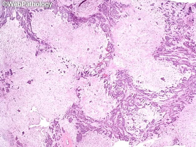 Histology of a pleomorphic adenoma involving the parotid gland. This light-microscopy image derives from a hematoxylin and eosin–stained paraffin section. It demonstrates a biphasic neoplasm with epithelial ductal–acinar elements embedded in a myxoid to chondromyxoid stroma. Epithelial components arrange as trabeculae, tubules, and duct-like acini, often lined by a two-layered cast: inner cuboidal to columnar luminal cells and outer basal/myoepithelial cells with plasmacytoid or spindle morphology. The surrounding stroma is variably myxoid, sometimes chondroid, producing a lobulated architecture with intimately interwoven cellular and stromal zones. Clefts and interspersed myxoid pools may be evident; ossification or calcifications are occasional. The lesion is typically well circumscribed within the parotid, showing no frank invasion of adjacent parenchyma on histology. Mitotic activity is rare. The overall appearance—myxoid/chondromyxoid matrix with epithelial tubules and ducts—supports pleomorphic adenoma; however, histologic overlap with other salivary gland neoplasms necessitates clinical correlation and, when indicated, ancillary immunohistochemistry (e.g., cytokeratin, S-100, GFAP) or molecular testing. Clinically, pleomorphic adenoma presents as a slow-growing, painless parotid mass in adults, with a favorable prognosis after complete surgical excision, though recurrence and potential for malignant transformation exist if spillage or capsular rupture occurs.