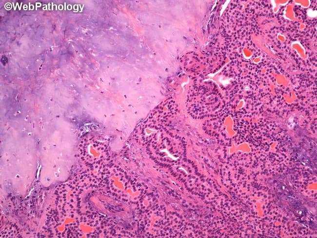 Histology, Light microscopy, Hematoxylin and Eosin stained section of a salivary gland mass. The epithelial component demonstrates ductal/acinar differentiation arranged in cords and small nests, with cuboidal to columnar cells and inconspicuous cytoplasm. Surrounding this proliferative epithelium is a abundant, hypocellular stromal background composed of chondromyxoid matrix with cartilaginous-like areas and occasional myxoid pools. The composite tissue exhibits a classic biphasic pattern typical of pleomorphic adenoma: epithelial/ductal elements embedded within a variably myxoid to chondroid stroma, often with myoepithelial cells contributing to the matrix. The lesion is circumscribed, showing well-defined limits without overt invasion into adjacent parotid tissue at this magnification. These features are diagnostic of a benign mixed tumor arising from salivary gland parenchyma. Clinically, this entity presents as a slow-growing, painless mass in the parotid region and has a low malignant potential. Differential considerations include other salivary gland neoplasms such as basal cell adenoma, mucoepidermoid carcinoma, and chondroid syringoma. Diagnostic significance lies in confirming a pleomorphic adenoma, guiding surgical planning toward complete excision with margin control to minimize recurrence risk. The image is optimal for teaching and research in head-and-neck pathology and salivary gland tumor histology. This image is valuable for medical education, pathology review, and diagnostic practice.