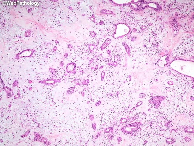 Low-power brightfield histology of a salivary gland tumor stained with hematoxylin and eosin reveals the classical pleomorphic adenoma pattern. The lesion is encapsulated within the parotid region, presenting as a benign, slow-growing mass. The epithelial component forms duct-like and acinar structures lined by a single layer of cuboidal to columnar cells, while an outer layer of neoplastic myoepithelial cells displays plasmacytoid, spindled, or stellate morphologies. The stroma is variably myxoid to chondroid, producing a heterogeneous, often cartilaginous appearance and imparting the 'pleomorphic' descriptor. Cellular atypia and mitotic activity are absent or minimal, consistent with benign behavior. The lesion demonstrates biphasic architecture with a mosaic of epithelial nests, cords, and tubules embedded in an abundant extracellular matrix rich in mucopolysaccharides and chondroid material; occasional hyalinization may be seen. Clinically, this histology corresponds to a pleomorphic adenoma, the most common benign salivary gland neoplasm, characteristically presenting in adults with a painless, mobile mass. Differential diagnoses include mucoepidermoid carcinoma, adenoid cystic carcinoma, and basal cell adenoma; however, the combination of ductal epithelial cells with myoepithelial myxochondroid stroma supports benign pleomorphic adenoma. The diagnostic significance lies in confirming a benign, surgically curable process requiring complete excision to minimize recurrence. Correlation with clinical exam advised today.
