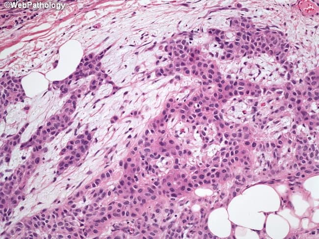 Histopathology of a salivary gland neoplasm (pleomorphic adenoma) demonstrated on hematoxylin and eosin stained tissue section examined by bright‑field light microscopy. The primary subject is a salivary gland tumor, most commonly arising in the parotid region. The specimen shows epithelial cells organized into anastomosing cords and tubular structures embedded in abundant myxoid to chondromyxoid stroma. The epithelial component includes duct‑like castings and nests of cuboidal to columnar cells with basophilic nuclei and minimal cytoplasm, often admixed with variably myoid, plasmacytoid cells representing myoepithelial differentiation. The background stroma is loose, richly mucoid, and occasionally hyalinized, occasionally containing focal adipose tissue islands at the periphery, a recognized but nonessential feature of pleomorphic adenoma. Notable features include cleft-like spaces and a biphasic appearance reflecting epithelial and myoepithelial elements within a chondromyxoid matrix. The regional architecture is typically well circumscribed, though microscopic invasion into adjacent fibrous stroma may occur in rare cases; this is a benign neoplasm with excellent prognosis after complete excision. Diagnostic significance lies in recognizing the mixed epithelial/myoepithelial phenotype with myxoid stroma, differentiating from mucoepidermoid, adenoid cystic carcinoma, or canalicular lesions. Clinically, this histology supports diagnosis of pleomorphic adenoma and informs surgical planning and prognosis.
