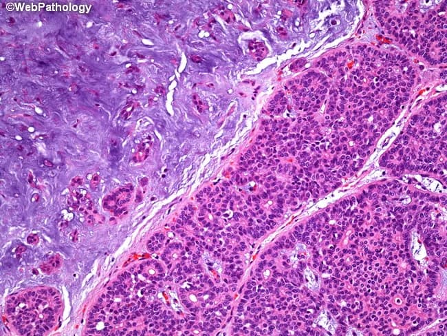 Imaging modality: light microscopy of hematoxylin and eosin stained paraffin-embedded salivary gland tissue from the parotid region. Anatomy: parotid gland tissue showing a classic biphasic neoplasm with epithelial elements intimately admixed with mesenchymal-like stroma. Description: Epithelial components form acinar and tubular structures, composed of duct‑forming cells and myoepithelial-like cells, set within a markedly hypocellular myxoid to chondromyxoid stroma. The epithelial nests are hypercellular in places and juxtaposed to expansive, basophilic stroma; the interface produces a biphasic appearance. The stroma often shows loose, lobulated myxoid material with mild chondroid differentiation, creating the distinctive mixed morphology. Overall, this pattern is typical of pleomorphic adenoma, a benign salivary gland tumor with epithelial–mesenchymal differentiation and typically a well circumscribed capsule. Diagnostic significance: the combination of acinar/tubular epithelial differentiation within a myxoid/chondromyxoid stroma strongly supports pleomorphic adenoma; differentiates from malignant salivary neoplasms. Differential considerations: mucoepidermoid carcinoma, adenoid cystic carcinoma, basal cell adenoma. Clinical correlation: presents as a slow-growing, painless parotid mass in adults; treatment usually involves complete surgical excision with facial nerve preservation and careful follow-up for recurrence. Potential applications: educational histology exemplar, pathology teaching repository, and radiology-pathology correlation studies. This image exemplifies classic pleomorphic adenoma histology suitable for teaching and diagnostic training in pathology education.