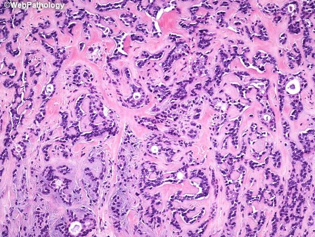 Classic pleomorphic adenoma of a salivary gland demonstrated on Hematoxylin and Eosin stained histology. The image shows a biphasic tumor with intimate admixture of ductal epithelial elements and myoepithelial cells set within a variably myxoid to hyalinized stromal background. Duct-like glands and small tubules are lined by cuboidal to columnar epithelial cells, often surrounding open lumina, while the surrounding myoepithelial cells appear plasmacytoid and can be dispersed within a basophilic, mucopolysaccharide rich matrix. The stroma ranges from loose basophilic myxoid zones to dense eosinophilic hyalinized areas and occasionally cartilaginous, chondromyxoid nodules. The lesion typically exhibits a well circumscribed or push‑invasion pattern with minimal cytologic atypia and low mitotic activity, consistent with benign behavior. This histologic constellation—epithelial–myoepithelial biphasic components set in a chondromyxoid stroma—defines pleomorphic adenoma and helps differentiate it from other salivary gland tumors. Clinically, such tumors present as slow‑growing, painless parotid masses in adults. Accurate diagnosis relies on recognizing the biphasic architecture and stromal diversity; treatment is surgical excision with adequate margins to prevent recurrence and rare malignant transformation (carcinoma ex pleomorphic adenoma). This slide serves as a representative educational reference for diagnostic pathology, head‑and‑neck oncology, and pathology teaching.