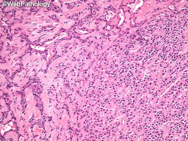 Imaging modality: light microscopy of Hematoxylin and Eosin stained histology section from a salivary gland lesion. Anatomical site: parotid region; histologic plane: peripheral-to-central glandular architecture. The slide reveals classic pleomorphic adenoma features with biphasic tumor components in a variably hyalinized, myxoid stroma. Epithelial nests and anastomosing cords are embedded in a chondromyxoid matrix, while duct-like tubules are evident in places. In the lower-right field, small nests and cords form an Indian file pattern, illustrating cellular diversity within a single tumor. The left third shows compressed and distorted tubular structures amid dense stromal hyalinization, contributing to a mosaic of microarchitectures. The myoepithelial element contributes spindle- to plasmacytoid cells with variable cytoplasmic appearance; the overall cytology lacks significant atypia or invasion. Clinically, these features correlate with a slow-growing, painless parotid mass and favorable prognosis after complete excision. Diagnostic significance rests on recognizing both epithelial and myoepithelial components within a mucoid to cartilaginous stroma, and on identifying variant patterns to avoid misclassification as malignant salivary neoplasms. Differential diagnoses include adenoid cystic carcinoma, mucoepidermoid carcinoma, and basal cell adenoma; accurate histologic interpretation guides management and recurrence risk assessment. Awareness of this histologic diversity improves diagnostic accuracy and informs surgical planning.
