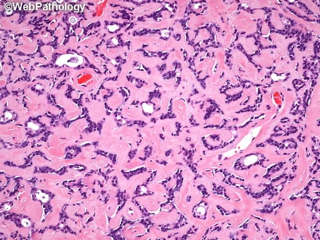 Pleomorphic adenoma of salivary gland on hematoxylin and eosin stained histology. This micrograph highlights abundant hyalinized eosinophilic matrix reminiscent of basement membrane material surrounding and intermingling with the tumor epithelium. The epithelial component forms tubular and acinar structures, composed of uniform cuboidal to columnar cells with basophilic nuclei and inconspicuous nucleoli. These duct- and acinus-like elements are variably compressed by the dense eosinophilic stroma, yielding a characteristic admixture of epithelial elements embedded within a predominantly hyalinized, fibrous background. The matrix material resembles basement membrane and may create a pseudo-cartilaginous appearance in other views, but in this field it constrains glandular architecture rather than producing well-developed cartilaginous differentiation. The overall pattern is typical of benign salivary gland neoplasia: a biphasic pattern with epithelial ductal elements and a myoepithelial/mesenchymal stroma, here dominantly hyalinized. The image is diagnostic of pleomorphic adenoma when correlated with clinical presentation (slow-growing, painless parotid mass) and radiologic assessment; however it also bears resemblance to basal cell adenoma in its basaloid epithelial proliferation. Clinically relevant features include the potential for local recurrence after incomplete excision if capsule breached. This myxoid-like matrix and tubular/acinar epithelial proliferation are pertinent for pathologic confirmation, surgical planning, and differential diagnosis in head and neck oncology.
