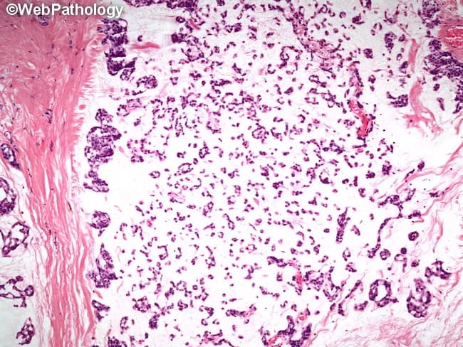 Histology image of a salivary gland tumor demonstrating classic pleomorphic adenoma (mixed tumor). Prepared as a hematoxylin and eosin stained slide and evaluated under light microscopy. The specimen represents salivary gland tissue in the parotid region. Epithelial elements are organized into small nests and rudimentary tubular structures, reflecting ductal differentiation. These epithelial components are embedded in a substantial myxoid background with scattered chondromyxoid areas. Myoepithelial cells contribute to the cellular admixture, accounting for variable cell shapes and occasional plasmacytoid appearances. The stroma ranges from loose, myxoid to more fibrous or hyaline areas, producing a heterogeneous, biphasic architecture typical of pleomorphic adenoma. The overall pattern is benign-appearing with well-demarcated margins in this field; however, the lesion is known for potential recurrence if incompletely excised. Pleomorphic adenoma is a benign salivary gland neoplasm featuring epithelial and myoepithelial components within mucoid and cartilaginous stroma. Diagnostic significance rests on recognizing the biphasic morphology and chondromyxoid matrix, which helps distinguish from malignant mimics such as mucoepidermoid carcinoma or adenoid cystic carcinoma. Clinically, these findings correlate with a slow-growing, painless parotid mass in middle-aged adults. This image is valuable for education, differential diagnosis practice, and radiology-pathology correlation in salivary gland tumors. for clinical education and research.