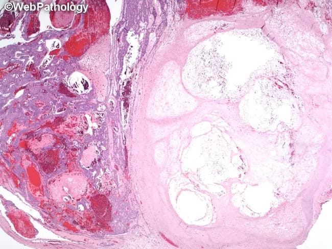 This is a histopathology slide of a salivary gland lesion, specifically a pleomorphic adenoma, showing post‑biopsy changes. The left half of the tumor demonstrates prominent hemorrhage with extravasated red cells and congested stroma, while the right half contains an infarcted nodule with coagulative features and ghosted cellular outlines. The lesion is composed of biphasic components characteristic of pleomorphic adenoma: duct‑forming epithelial cells arranged in cords within a myoepithelial-rich stroma that ranges from myxoid to chondroid, with areas of hyalinization. The infarcted region displays coagulative necrosis with preservation of overall architecture but loss of viable cytoplasm in many cells. The hemorrhagic component reflects biopsy‑related vascular injury following fine‑needle aspiration biopsy (FNA), a known iatrogenic change. The contrast between hemorrhagic zones and infarcted nodules can mimic malignant necrosis if not interpreted in context. Clinically, this image highlights the need to correlate cytology/fine needle aspiration findings with histology to avoid overcalling malignancy in post‑procedural salivary gland lesions. Diagnostic significance: FNA‑induced hemorrhage and infarction within pleomorphic adenoma; typical histology of benign salivary gland tumor preserved elsewhere; no overt atypia or invasive growth detected. Potential use cases: education, differential diagnosis in salivary gland tumors, radiology-pathology correlation, biopsy artifact recognition, pathology review.