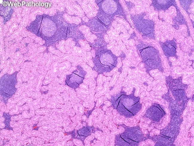 This histopathology image demonstrates a Warthin tumor of the parotid gland in a low-power light micrograph. Papillary and tubular epithelial proliferations are lined by a bilayered, oncocytic epithelium with abundant eosinophilic granular cytoplasm rich in mitochondria. The neoplastic epithelium sits within dense lymphoid stroma containing conspicuous germinal centers, reflecting the characteristic biphasic architecture of papillary cystadenoma lymphomatosum. PTAH staining reveals blue-black cytoplasmic granules within oncocytic cells, highlighting mitochondrial content and cytoplasmic granularity. The combination of bilayered oncocytic epithelium forming papillary/tubular structures and a prominent lymphoid stroma with germinal centers is diagnostic for Warthin tumor, a benign salivary gland neoplasm most often arising in the parotid region. This image supports differential diagnosis against pleomorphic adenoma and mucoepidermoid carcinoma; clinical correlation includes patient age, smoking history, and parotid mass presentation. The technical context—PTAH histochemistry on a parotid tissue section at low magnification—facilitates recognition of the epithelial/lymphoid biphasic pattern and mitochondria-rich cytoplasm; relevant for pathology education, QA, and histology atlases. This image is valuable for teaching residents, fellows, and students about salivary gland oncocytic tumors; PTAH cytoplasmic granules provide histochemical corroboration of mitochondrial abundance. Correlating morphology with immunohistochemistry may exclude more cellular carcinomas. The image underscores the importance of recognizing stromal-epithelial biphasic architecture in parotid neoplasms and the characteristic lymphoid germinal centers.