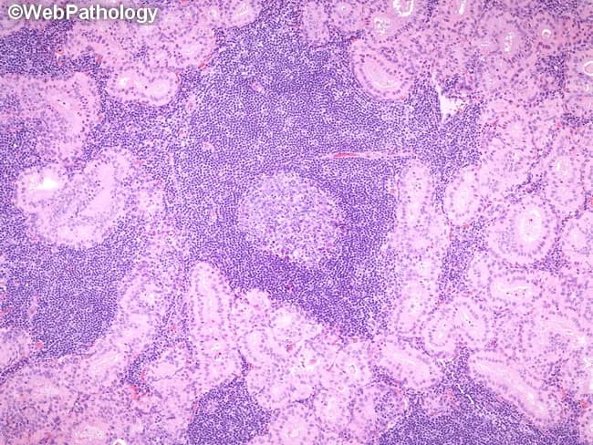 A histopathologic image of a parotid gland Warthin tumor (papillary cystadenoma lymphomatosum) obtained from surgical resections, demonstrated with bright-field microscopy after Hematoxylin and Eosin staining. The epithelial component forms tubular and papillary structures lined by a bilayered epithelium: an inner tall columnar luminal cell layer and an outer cuboidal oncocytic layer. These epithelial cords are embedded within a dense lymphoid stroma containing prominent germinal centers and a mixed inflammatory infiltrate. Immunophenotype in the accompanying description notes cytokeratin positivity of the epithelium (CK7, CK8, CK18, CK19) and a predominantly polyclonal B-cell population with IgA-producing cells, along with scattered T-cells, mast cells, and S-100 positive dendritic cells in the stroma. The combination of oncocytic epithelium and lymphoid-rich stroma with germinal centers is characteristic for Warthin tumor and helps distinguish it from pleomorphic adenoma or mucoepidermoid carcinoma. Clinically, this lesion is benign with favorable prognosis after parotidectomy. The high magnification view emphasizes dense lymphoid infiltrate, organized germinal centers, and the biphasic architecture. This image is valuable for diagnostic education, histology teaching files, and reference databases for head and neck pathology. It supports differential diagnosis, correlates with immunohistochemistry, and serves as a teaching exemplar for students and trainees in residency.