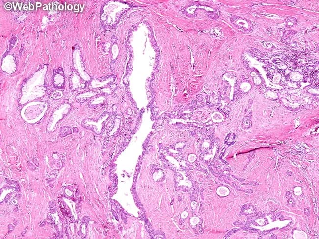 High‑quality brightfield light microscopy of a salivary gland tumor demonstrates classic mucoepidermoid carcinoma features. The specimen is a tissue biopsy from the parotid region, prepared as an H&E stained slide, viewed in routine cross‑sectional orientation. The architecture consists of cystic and gland‑like spaces intermingled with solid nests of epithelial cells. Mucinous cells display goblet or balloon‑like cytoplasm with abundant foamy material and small, dark, peripheral nuclei; these are juxtaposed with epidermoid (squamous) cells showing intercellular bridges and more eosinophilic cytoplasm. Intermediate cells occupy an intermediate phenotype between mucous and squamous elements. Clear cells, when present, contribute to the heterogeneous cell population. In low‑grade MEC, cyst lining is often simple to complex and may reveal cribriform and papillary patterns, with mucous cells predominating and relatively mild cytologic atypia. The surrounding stroma is fibrous and variably myxoid, sometimes with chronic inflammatory infiltrate. The overall impression is a largely cystic, low‑grade malignant neoplasm composed of mucous, squamous, intermediate, and, less frequently, clear cells, consistent with mucoepidermoid carcinoma. Clinically, MECs arise in salivary glands and carry prognostic significance dependent on grade. Lower grade lesions tend to be more cystic with better prognosis than higher grade, solid, infiltrative tumors. This image exemplifies classic MEC histology.