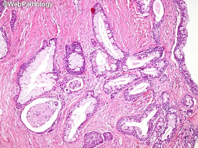 Mucoepidermoid carcinoma is depicted as a salivary gland neoplasm characterized by a heterogeneous mix of mucin-producing goblet-like cells, squamous (epidermoid) cells, intermediate cells, and clear cells arranged in cystic, glandular, and solid compartments. In this low‑grade example, the lesion demonstrates prominent cystic spaces lined by mucinous epithelium admixed with small nests of epidermoid cells. The mucous cells are frequently balloon‑shaped with abundant foamy cytoplasm and peripheral, often small nuclei; in other foci they form mucin-rich columns resembling glands. The overall architecture ranges from simple cysts to cribriform and papillary patterns, reflecting duct‑like differentiation within a hyalinized stroma. Solid nests of epidermoid cells may be interspersed with mucinous elements, producing a biphasic to triphasic cellular spectrum. Immunohistochemical or ancillary testing (where available) can substantiate mucous differentiation, but on routine H&E this triad of mucous, epidermoid, and intermediate cells suffices for recognition of MEC. The presence of mucin production, cystic decomposition, and duct‑like architecture is diagnostically significant, distinguishing MEC from other salivary gland tumors such as adenoid cystic carcinoma or pleomorphic adenoma. Clinically, these low-grade lesions tend to have favorable prognosis with surgical excision; higher grade variants exhibit more solid growth and aggressive behavior, guiding management and follow‑up.